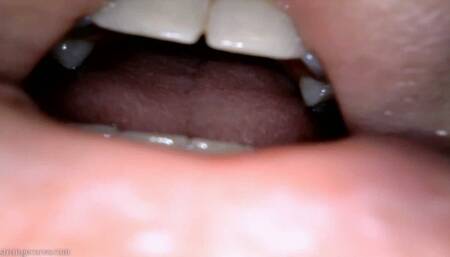 burp endoscopy (720 wmv)