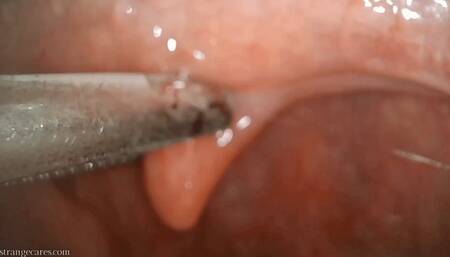uvula manipulation with swab and forceps (720 mp4)
