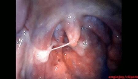 Big phlegm ENDOSCOPY