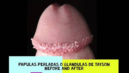 Tayson's glands or pearly papules