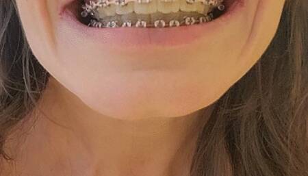 Cute Girl with Braces