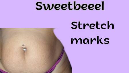 Stretch marks