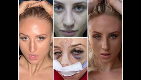 NOSE JOB RECOVERY PROCESS-FROM CONSULT TO SURGERY TO CAST OFF