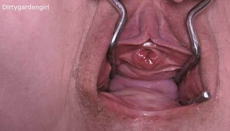 Close Up Urethra & Cervix Prolapse