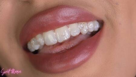 A new aligners update video | Sweet Maria