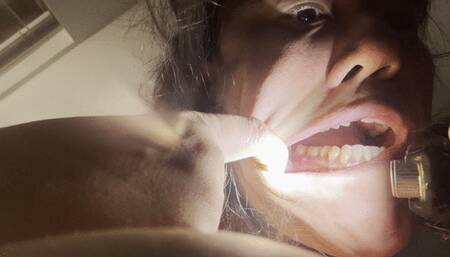 See my oral fistula and help me get a root canal soon (July 25 2025)