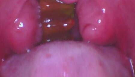 Gummy Bear Swallow ENDOSCOPE