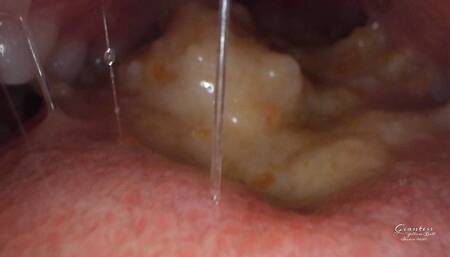 close up endomouth view