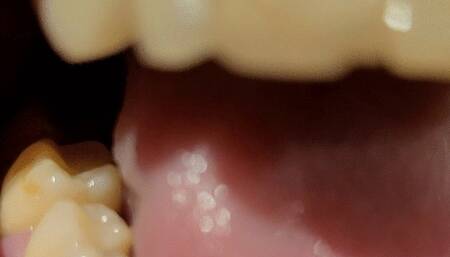 A new missing tooth! A tooth broke, teeth are rotten than ever - nicotine efects