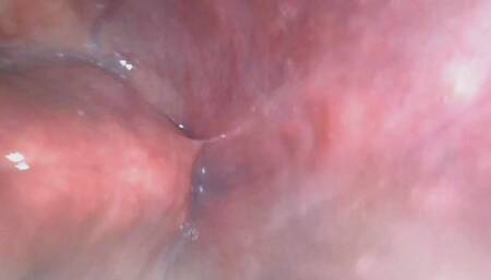 Kelseys Throat (AMAZING ENDOSCOPE FOOTAGE)