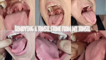 Removing a tonsil stone from my tonsil